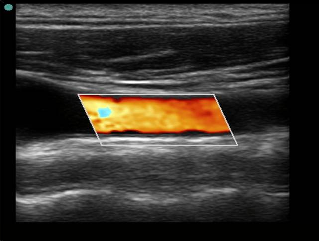Ultrasound Carotid Artery Disease